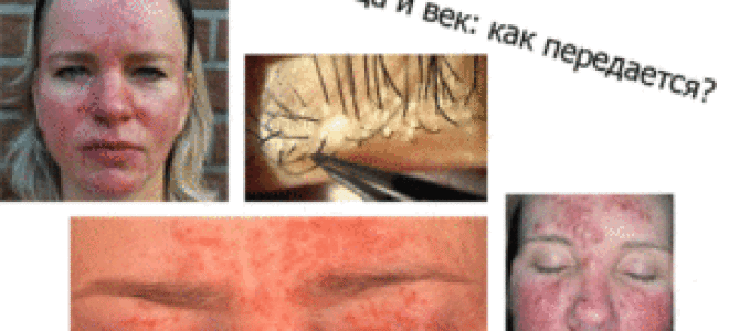 Клещ демодекс: как можно заразиться