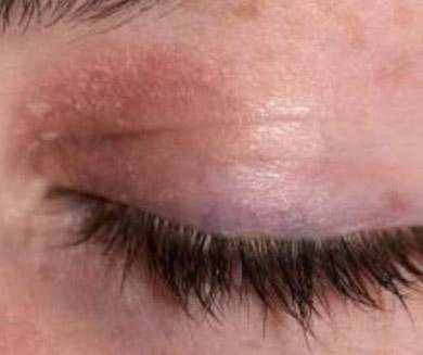 Шелушение и покраснение кожи вокруг глаз - причины и лечение thumbnail