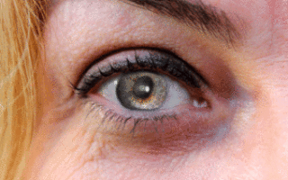 Первичная глаукома