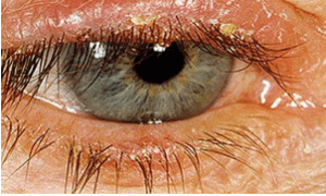 Демодекозный блефарит: симптомы и лечение