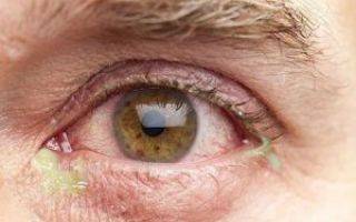 Народные средства для снятия воспаления глаз в домашних условиях