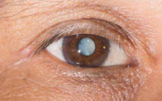 О чем расскажут пятна на глазных яблоках: виды, болезни и лечение