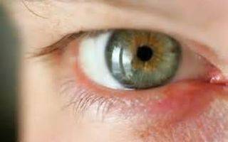 Куриная слепота у человека. причины возникновения и лечение гемералопии