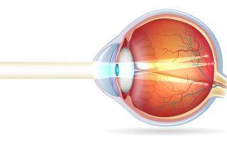 Что такое сложный астигматизм обоих глаз: лечение и коррекция у детей и взрослых