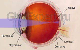 Что такое миопия глаза