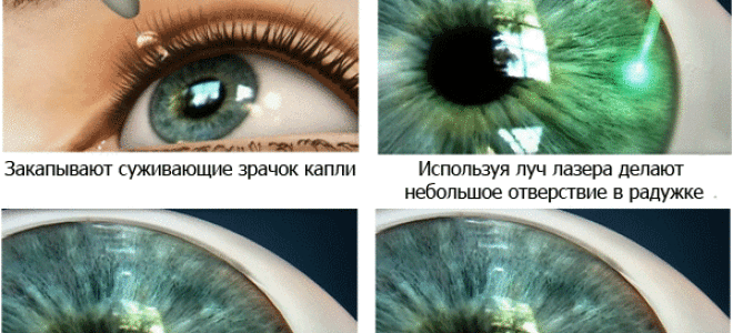 Лазерная иридэктомия (иридотомия)