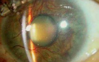 Закрытоугольная глаукома: первичная, вторичная, острый приступ