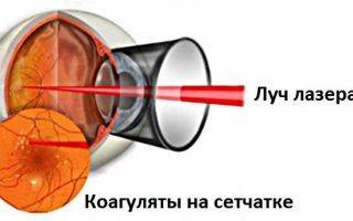 До и после лазерной коагуляции сетчатки глаза