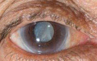 Черника для зрения: помогает ли для улучшения зрения, чем полезна для глаз, таблетки и витамины с экстрактом растения
