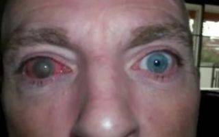 Первая помощь при травме глаза. чего категорически нельзя делать при травме глаза