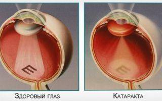 Операция по удалению катаракты