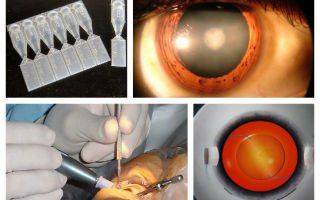 Способы лечения катаракты