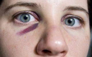 Синяк под глазом или параорбитальная гематома. как быстро убрать?