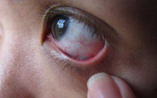 Почему порвалась линза для глаз и что нужно делать, если это произошло?