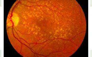 Атеросклероз сетчатки глаза: что это такое, симптомы и лечение