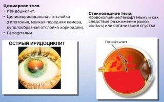 Гемофтальм код по мкб 10: лечение левого и правого глаза у взрослых