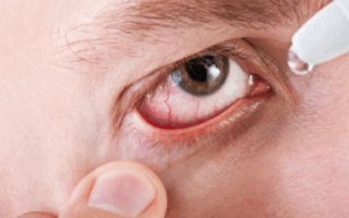 Симптомы и лечение демодекоза глаз