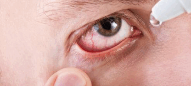 Симптомы и лечение демодекоза глаз