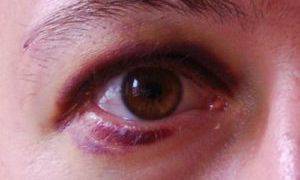 Что такое глазная контузия и как ее лечить