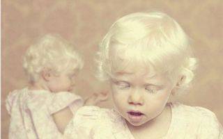 Альбинизм, причины болезни и ее лечение