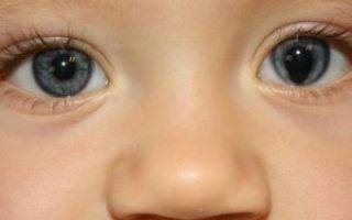 Что такое колобома глаза: есть ли опасность для зрения и нужно ли лечить