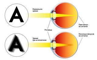 Формы и виды нарушения рефракции глаза