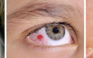 Кровоподтек в глазу: причины и лечение. сколько проходит кровоподтек в глазу