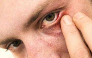 Как лечить воспаление глаза в домашних условиях