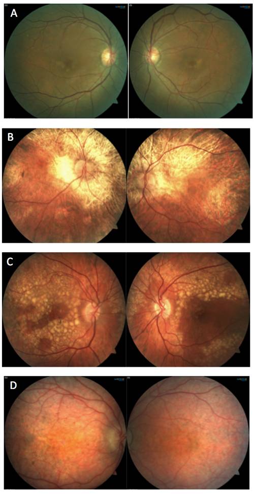 Амавроз лебера: причины и лечение заболевания глаз - полной слепоты врожденной