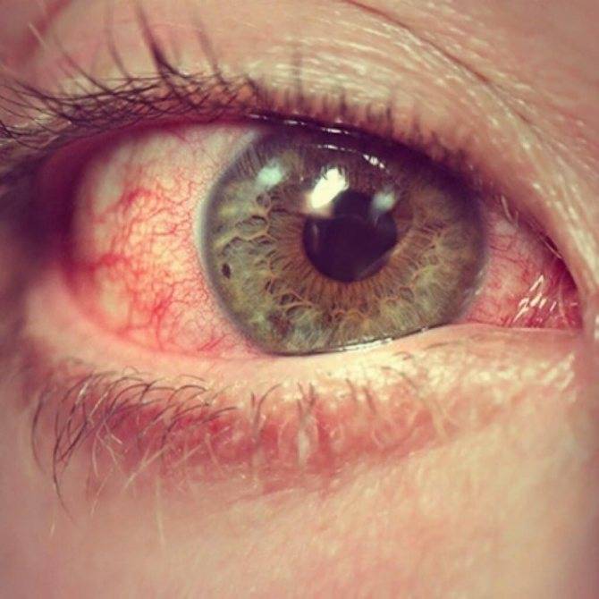 О чём говорят красные глаза и что с ними делать