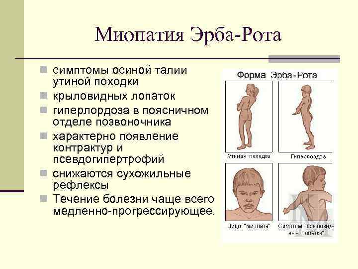 Миопатия дюшена. что это такое, симптомы у детей, взрослых, лечение