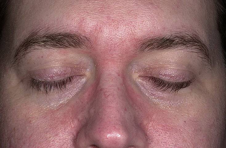 Аллергический дерматит на глазах: лечение заболевания