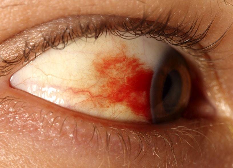 Воспаление сосудов глаза – причины, лечение