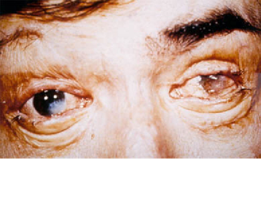 Ожог глаз кварцевой лампой: признаки, первая помощь и лечение