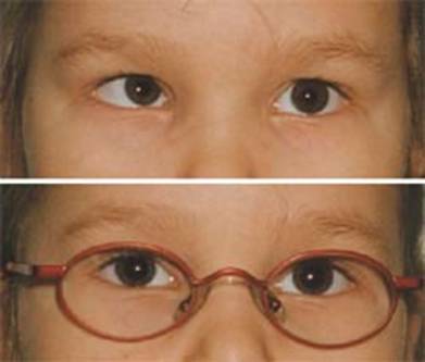 Как проявляется альтернирующее косоглазие? — глаза эксперт