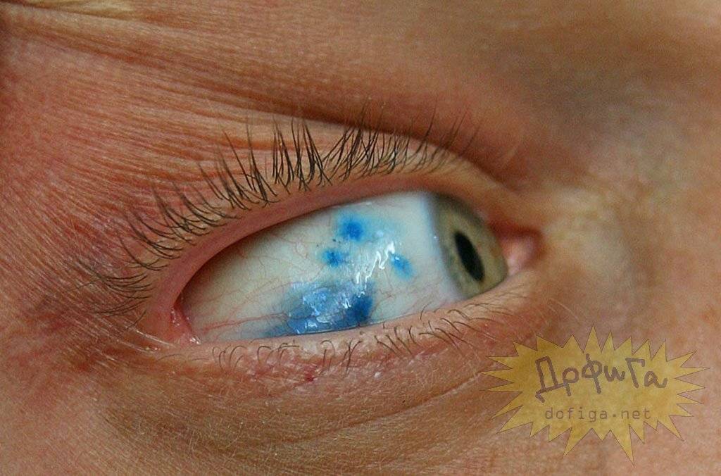 Причины желтых белков глаз: какую болезнь надо лечить?