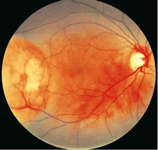 Невус хориоидеи глаза: симптомы и лечение
