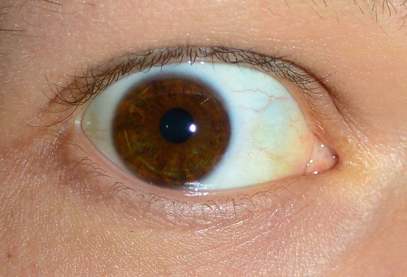 Желтое пятно в глазу – у человека на глазном яблоке или зрачках