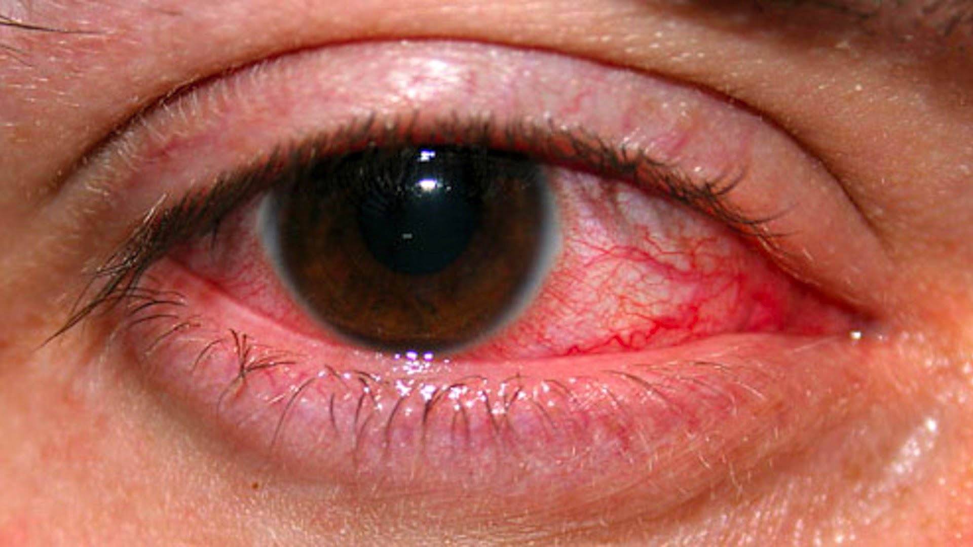 Воспаление глаз - лечение покраснения и воспалительных заболеваний в домашних условиях