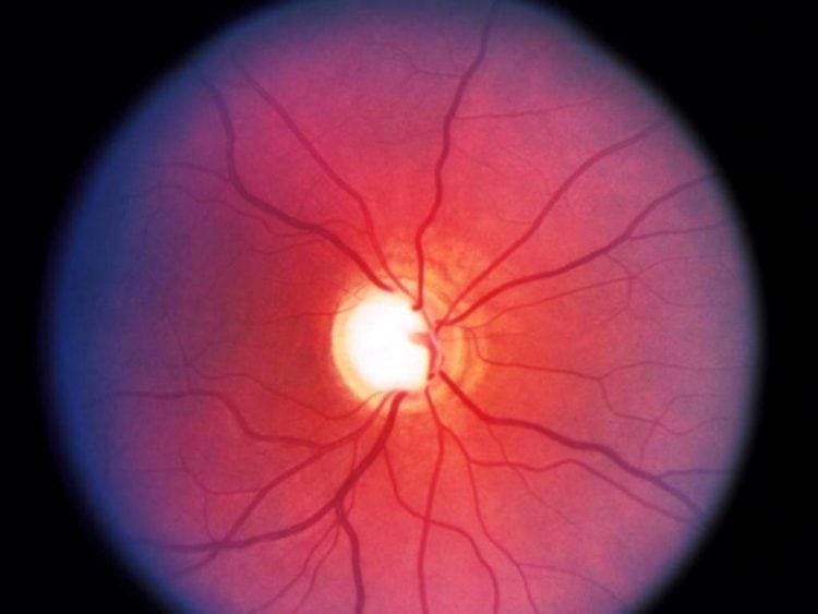 Ишемическая нейропатия зрительного нерва: лечение, симптомы