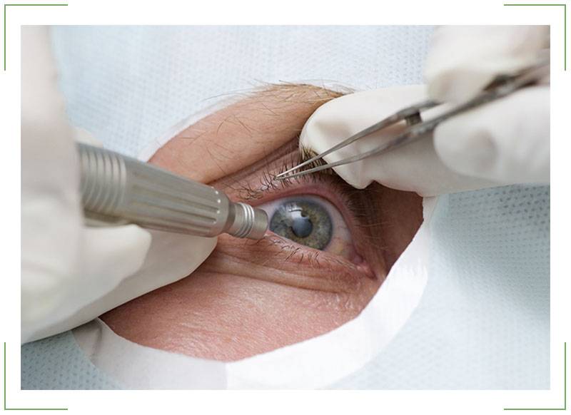 Незрелая катаракта: причины, симптомы, лечение, диагностика, виды (возрастная, сенильная, набухшая), профилактика, операция