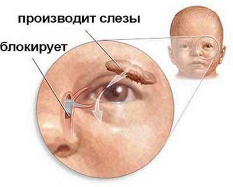 Массаж слезного канала у новорожденного - "здоровое око"