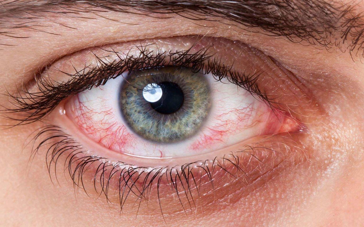 Причины жжения в глазах, покраснения, боли и светобоязни – лечение
