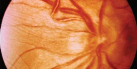 Ангиосклероз сетчатки глаза