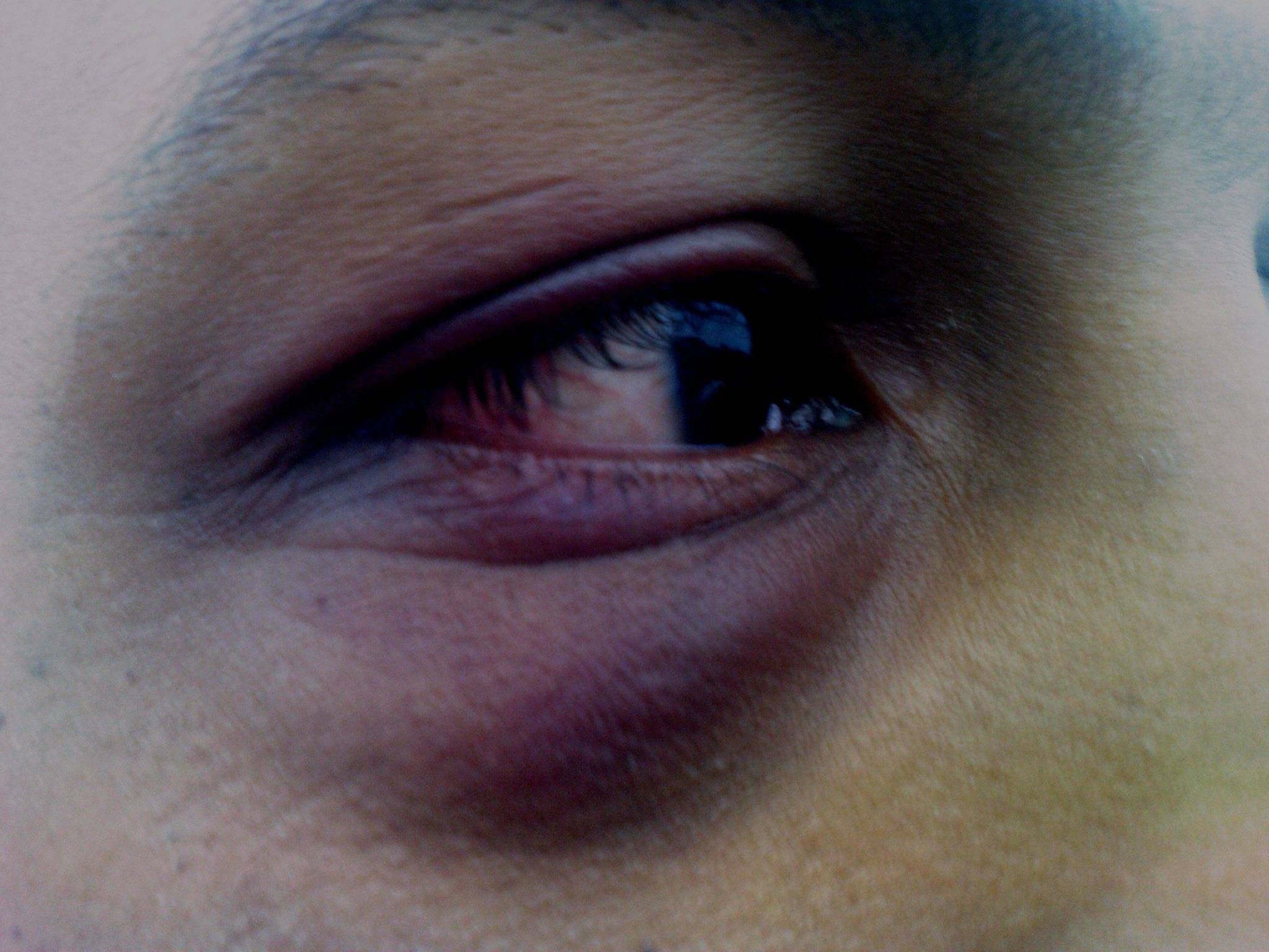 Синяк под глазом без ушиба - причины появления, лечение