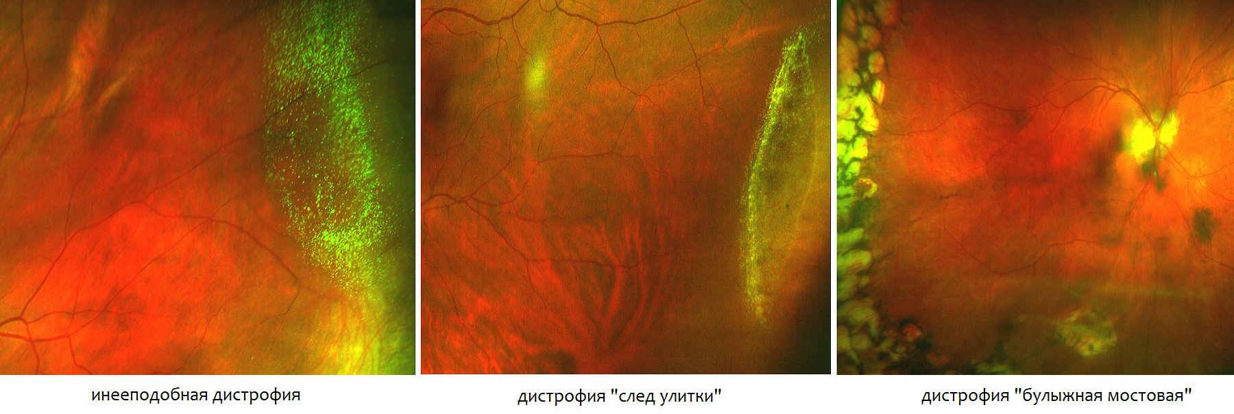 Чем опасна дистрофия сетчатки глаза и как распознать патологию?