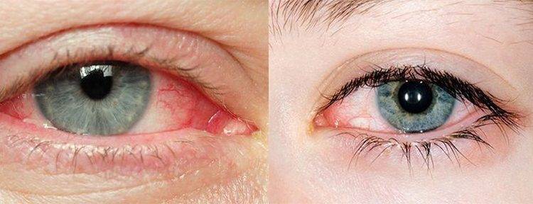 Плёнка на глазах — причины, симптомы, методы лечения