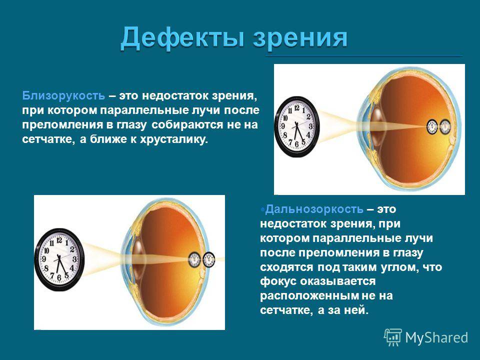 Близорукость: это минус или плюс, какие очки и линзы применяют при миопии