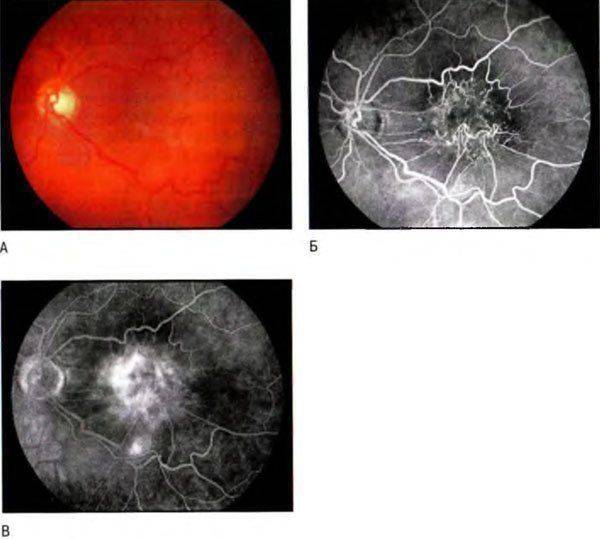 Эпиретинальный фиброз сетчатки, причины, симптомы, лечение - "здоровое око"