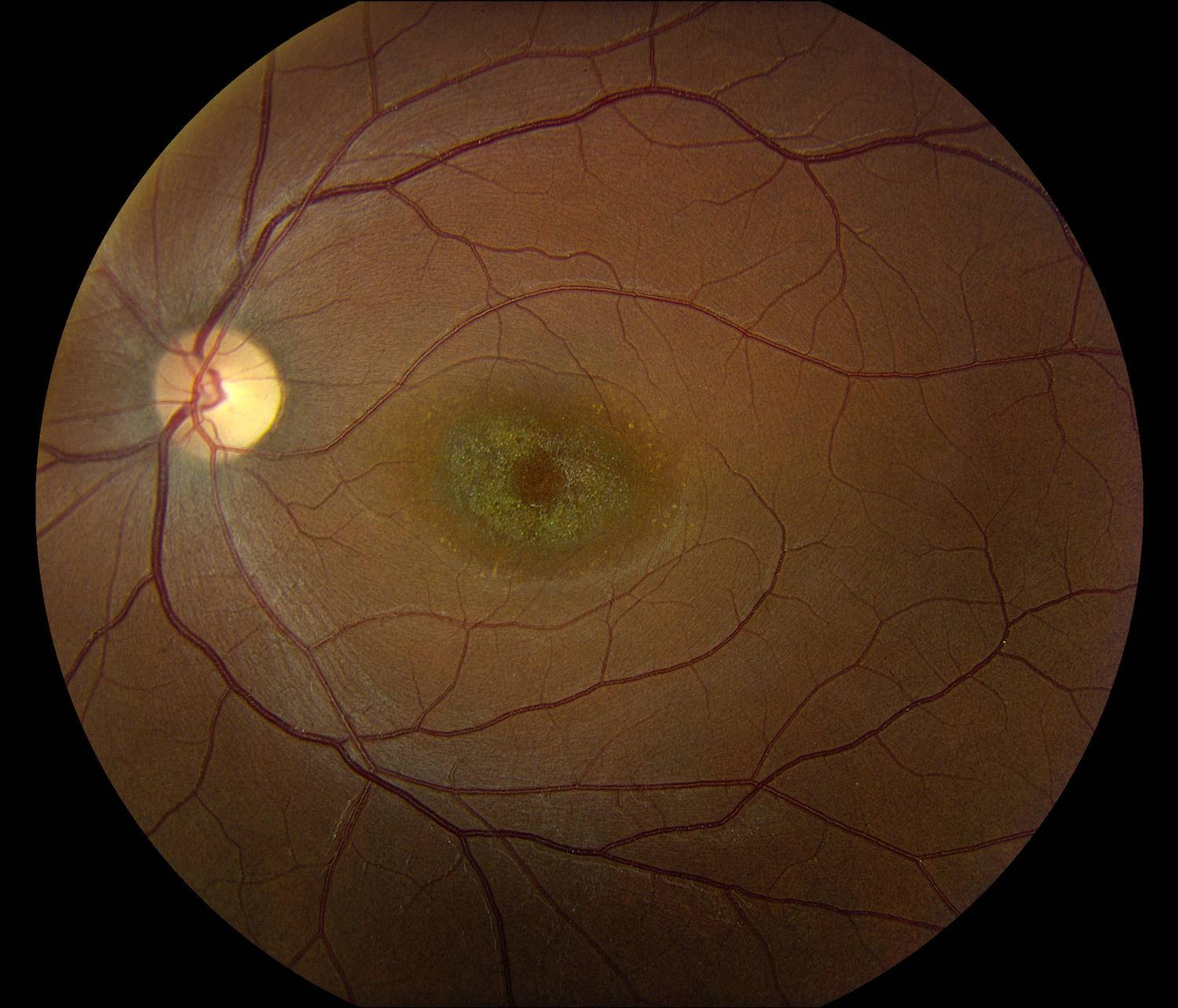 Ангиопатия сосудов сетчатки глаза - "здоровое око"